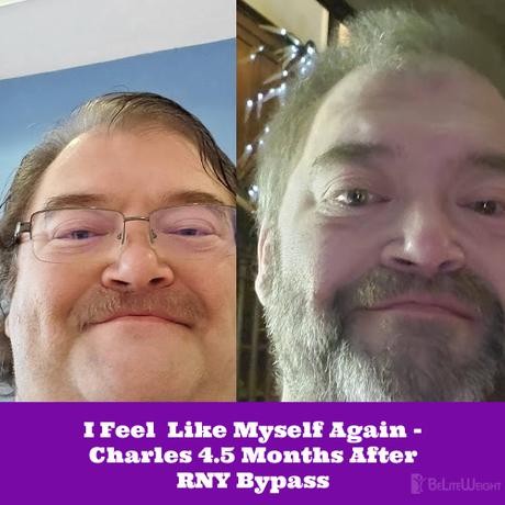 I Feel  Like Myself Again – Charles 4.5 Months After RNY Bypass