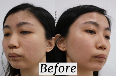 How I Reduce Pigmentation with Q Switch Laser Treatment | IDS Clinic