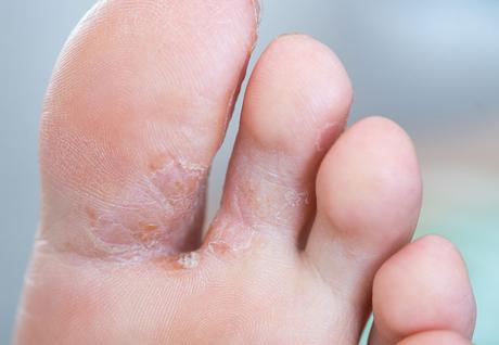 HOME REMEDIES FOR FUNGAL INFECTIONS