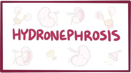 HYDRONEPHROSIS