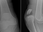 Ayurvedic Treatment Knee Dislocation