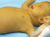 Jaundice Neonatal