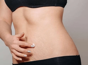 Ayurvedic Remedies Stretch Marks