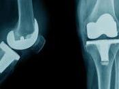 Most Common Symptoms Loose Knee Replacement