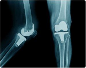 7 Most Common Symptoms of a Loose Knee Replacement