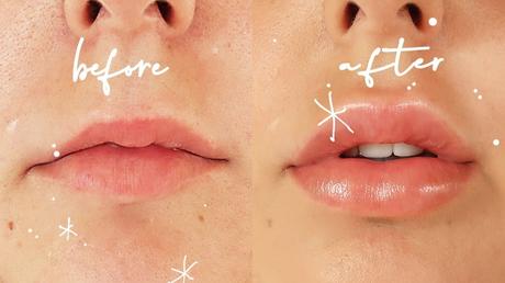 What Should You Know Before Getting Fillers In Your Lips?