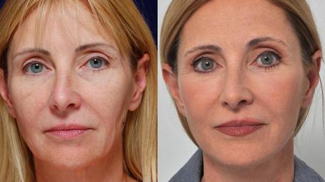 What is a Facelift? Should You Go For It?