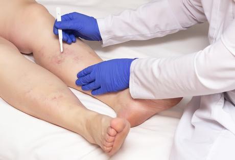 Early Symptoms of Spider Veins – Things You Should Never Ignore