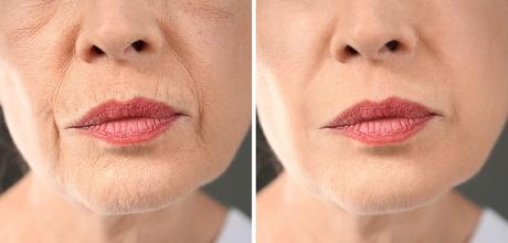 What are the Pros and Cons of a Facelift?