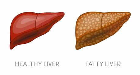 FATTY LIVER