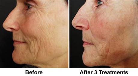 But is it right for you? Microneedling - Paramus, NJ | Create New Collagen
