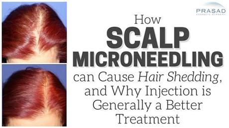 Microneedling has become an increasingly popular treatment. How Scalp Microneedling can Cause Temporary Hair Shedding ...
