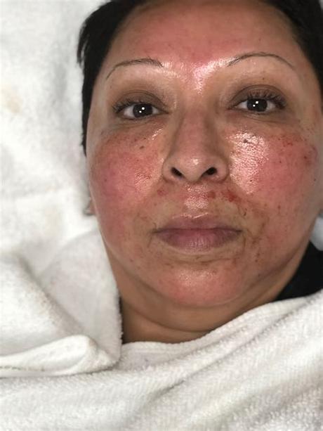 Microneedling is a minimally invasive treatment designed to reduce the look of scars, wrinkles, and lax skin. ANDE LIKES: MICRONEEDLING - The Beauty Blog