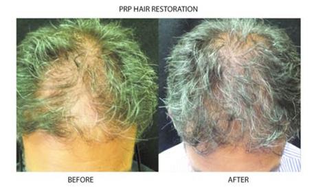 Microneedling has become an increasingly popular treatment. PRP Microneedling and Hair Restoration | New York City ...