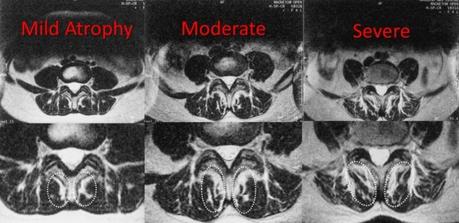 Multifidus Pain: A New Free Study for Patients with Ongoing Low Back Pain