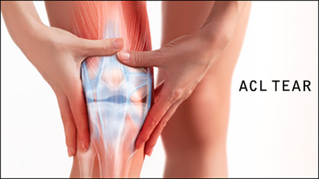 Ayurvedic Treatment of ACL Tear Without Surgery