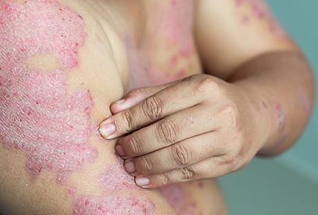 PSORIASIS PSORIASIS