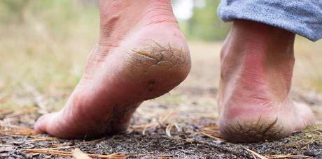 PADADARI OR CRACKED HEALS