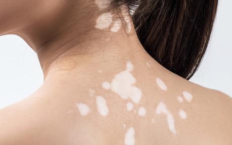 LEUCODERMA/VITILIGO LEUCODERMA/VITILIGO