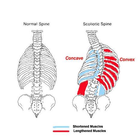 Degenerative Scoliosis? Exciting New Non-surgical Treatment Option