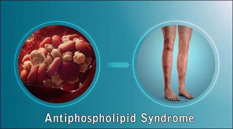 Ayurvedic Treatment of Antiphospholipid Syndrome