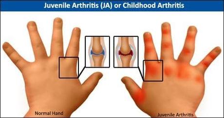 AYURVEDIC MANAGEMENT OF JUVENILE ARTHRITIS