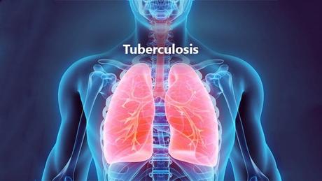 Tuberculosis (Rajayakshma)