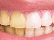 Natural Teeth Whitening Tips