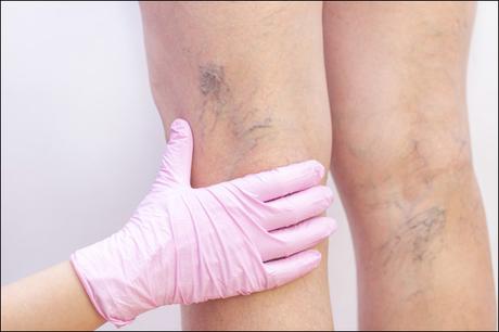 Treatment of Dvt/ Varicose Vein (Sira Vikar) in Ayurveda