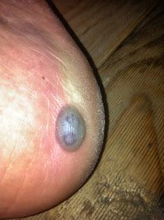 blister on outside of right foot  