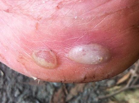 two blisters on side of foot