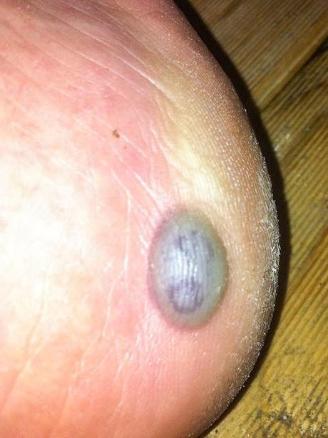blister on side of right foot