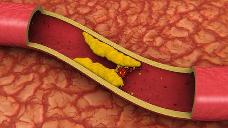 Remedies for Blocked Arteries Remedies for Blocked Arteries