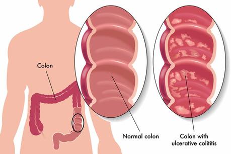 Ulcerative Colitis Ulcerative Colitis