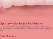 Receding Gums: Symptoms, Causes Treatment