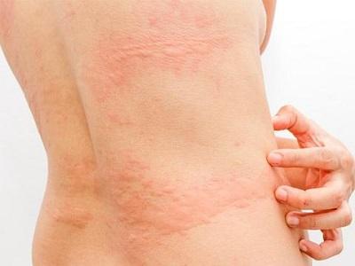 Skin Rashes