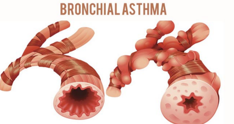 Bronchial Asthma (Tamaka Shwasa) Bronchial Asthma (Tamaka Shwasa)