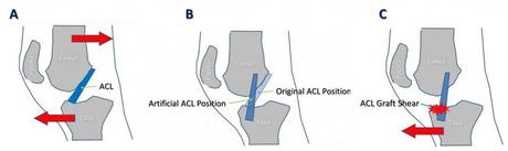 How Likely Is a Second ACL Tear On the Same Knee?