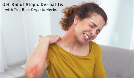 Get Rid of Atopic Dermatitis with Herbal Remedies