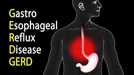 GASTRO-ESOPHAGEAL REFLUX DISORDER {ACID REFLUX} GASTRO-ESOPHAGEAL REFLUX DISORDER {ACID REFLUX}
