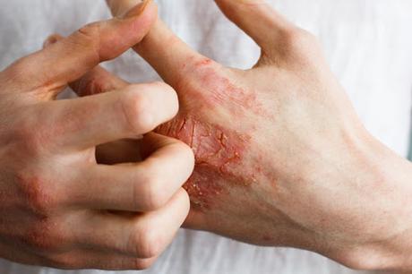 Eczema (Vicharchika) Eczema (Vicharchika)