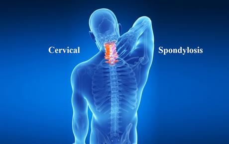 Cervical Spondylosis (Manyastambha) Cervical Spondylosis (Manyastambha)