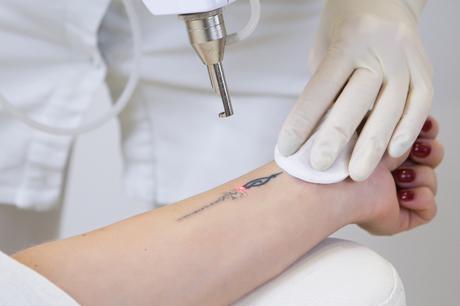 Visit The Best Laser Tattoo Removal Service For Quick Removal