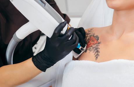Visit The Best Laser Tattoo Removal Service For Quick Removal