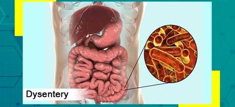 Dysentery (Parvahika)