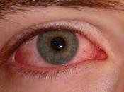 Ayurvedic Treatment Conjunctivitis, Herbal Remedies Causes Symptoms