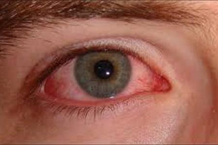 Ayurvedic Treatment for Conjunctivitis, Herbal Remedies – Causes & Symptoms