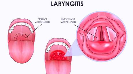 Herbal Remedies for Chronic Laryngitis, Ayurvedic Treatment – Causes & Symptoms