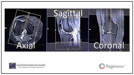 how to read knee MRI