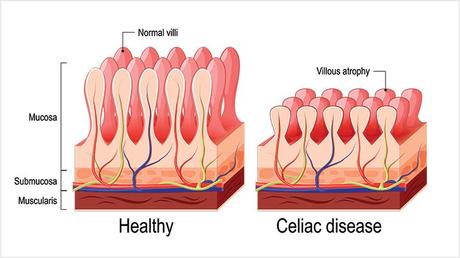 Celiac disease